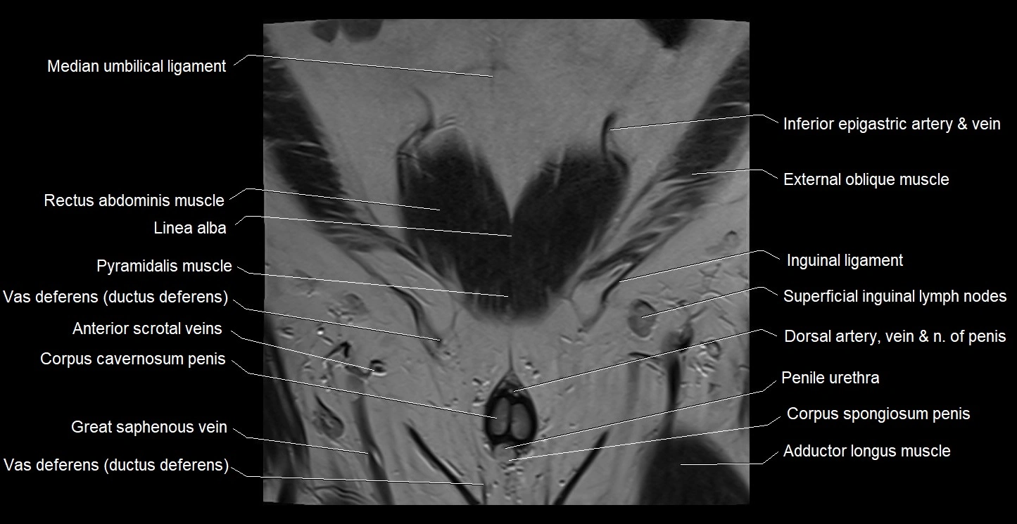 MRI coronal cross sectional anatomy male pelvis image 4.webp